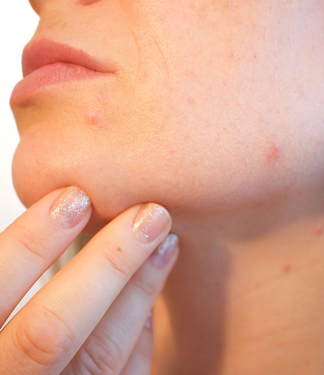 Antibiotic Treatment For Acne Can Impair Skeletal Growth In Adolescents F2