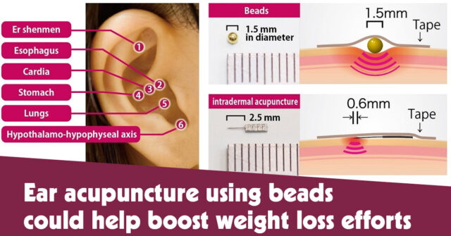 Ear Acupuncture Using Beads Could Help Boost Weight Loss Efforts F