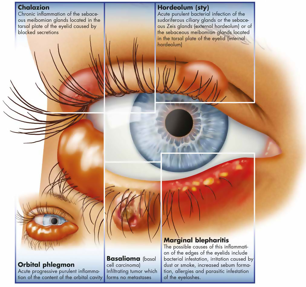 Whats The Difference Between A Meibomian Cyst And A Stye