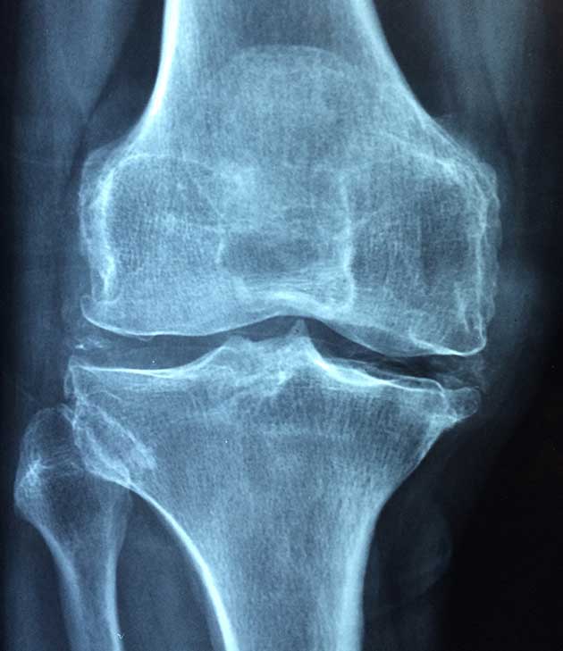 Research Has Found That Cortisone Injections Worsen Knee Osteoarthritis F2