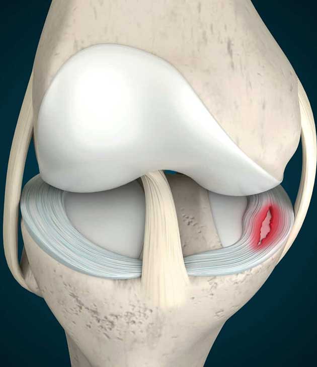 Torn Meniscus Surgery Is Still Too Unnecessary For Most People F2